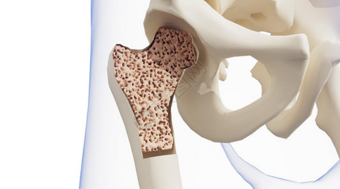 老年性骨质疏松症